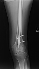Broken interlocking screws distal